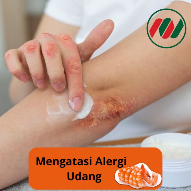 Mengatasi Alergi Udang Dan Cara Penanganannya